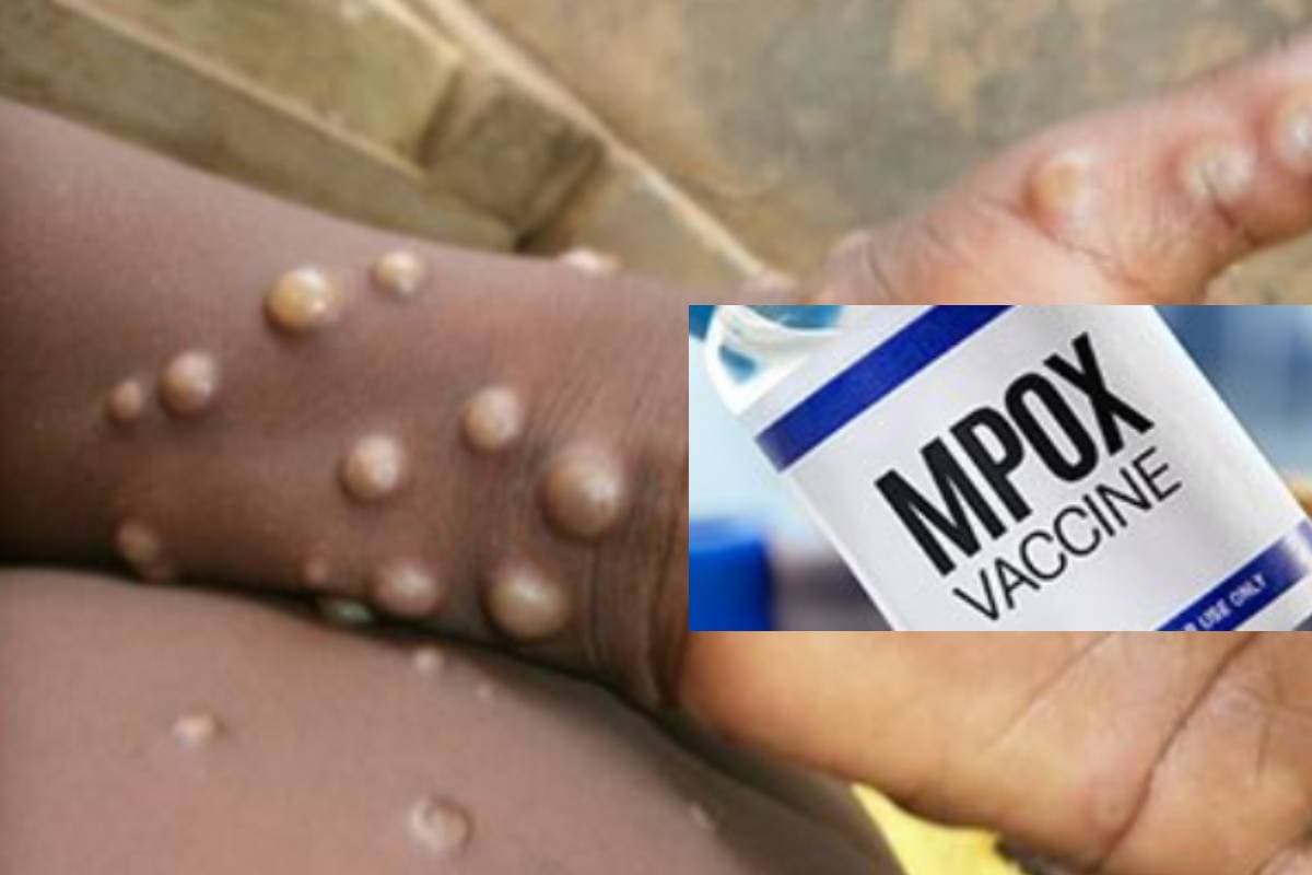 Mpox virus: पहले बुखार फिर चेहरे पर निकलता है दाना, मंकीपॉक्स ने बढ़ा दी दुनिया की टेंशन
