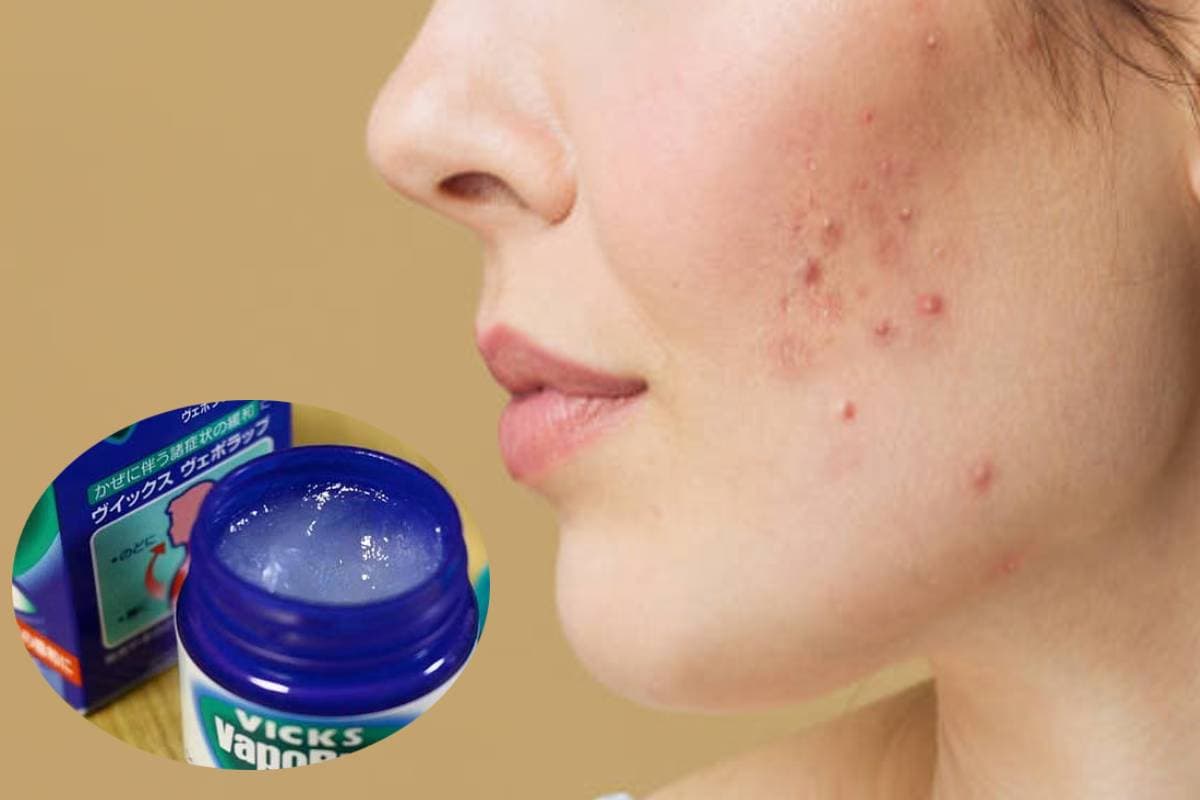 Beauty Hacks: चेहरे पर Vicks लगाने के चमत्कारी फायदे जान लें, हफ्तेभर में दिखेगा असर