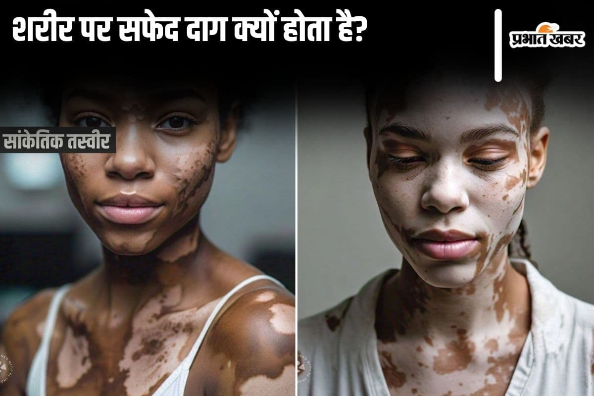 White Spot Disease: सफेद दाग किस उम्र में सबसे अधिक होता है? जानिए शरीर पर विटिलिगो क्यों होता है