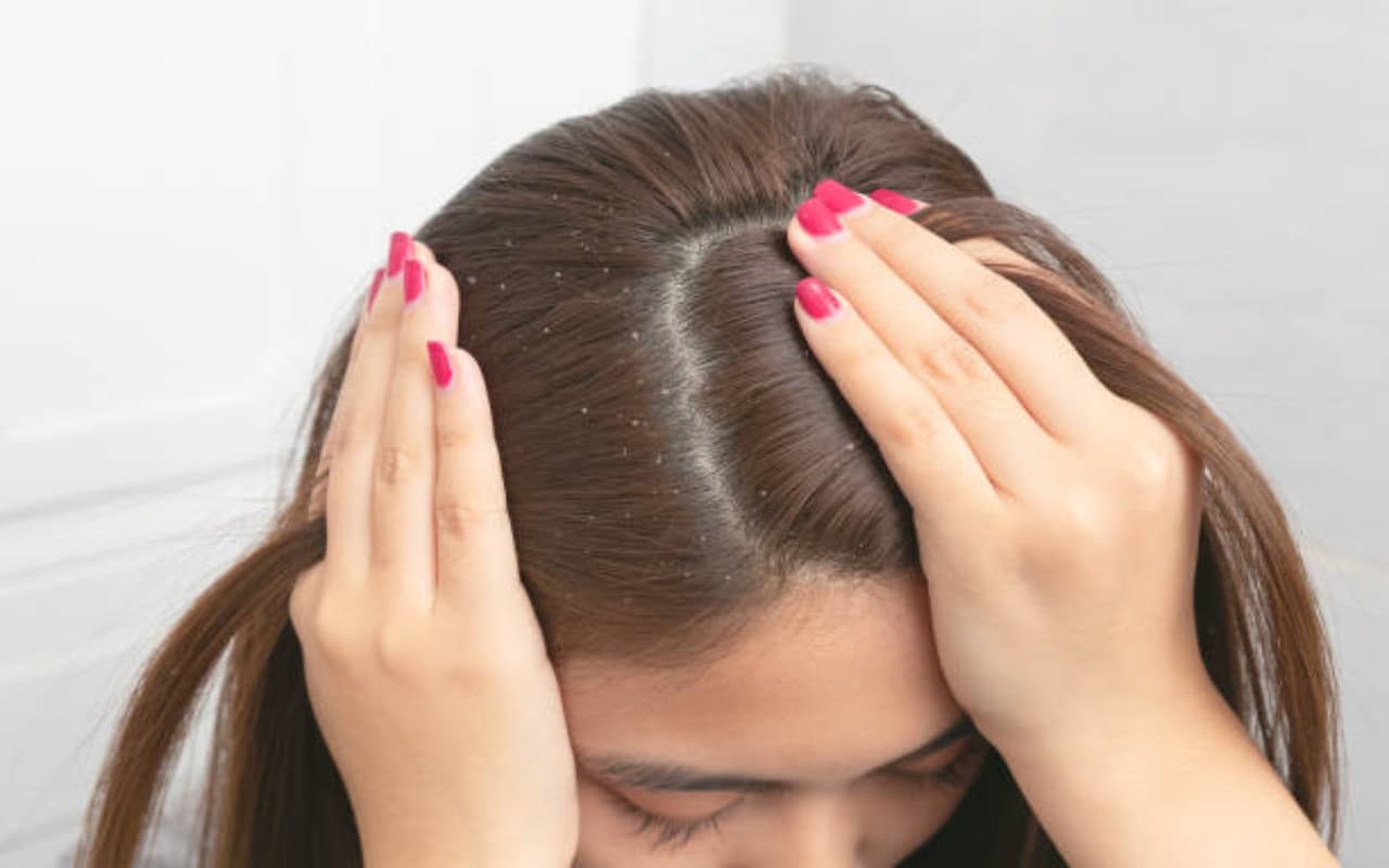 Dandruff: जड़ से खत्म हो जाएगी डैंड्रफ की समस्या, इस तरह घर पर तैयार करें हेयर मास्क
