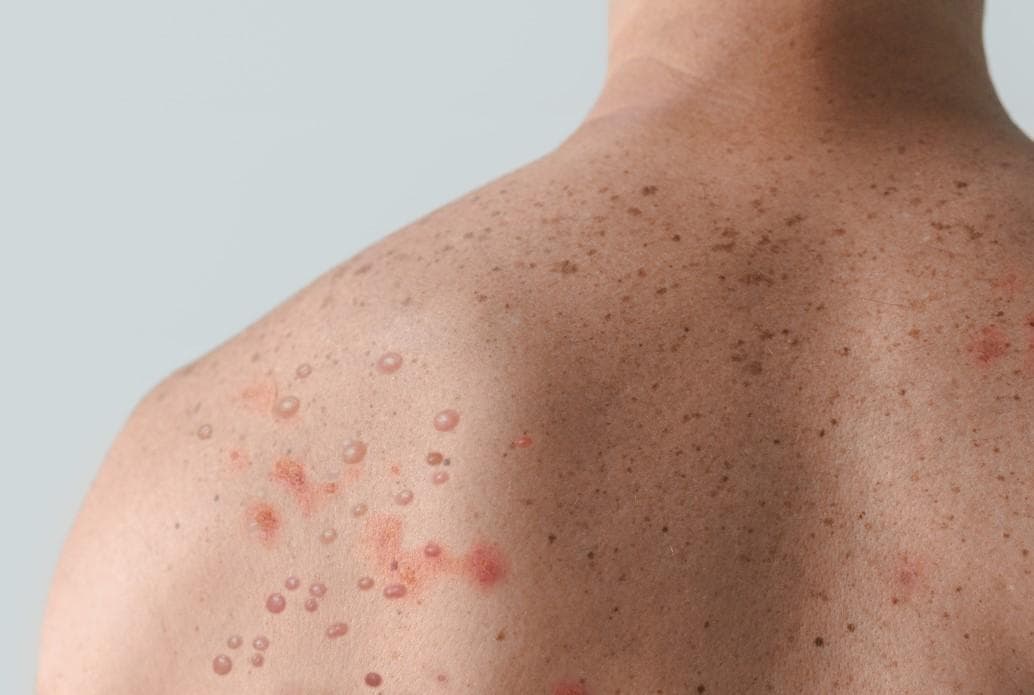 राज्य में मंकी पॉक्स को लेकर एडवाइजरी जारी