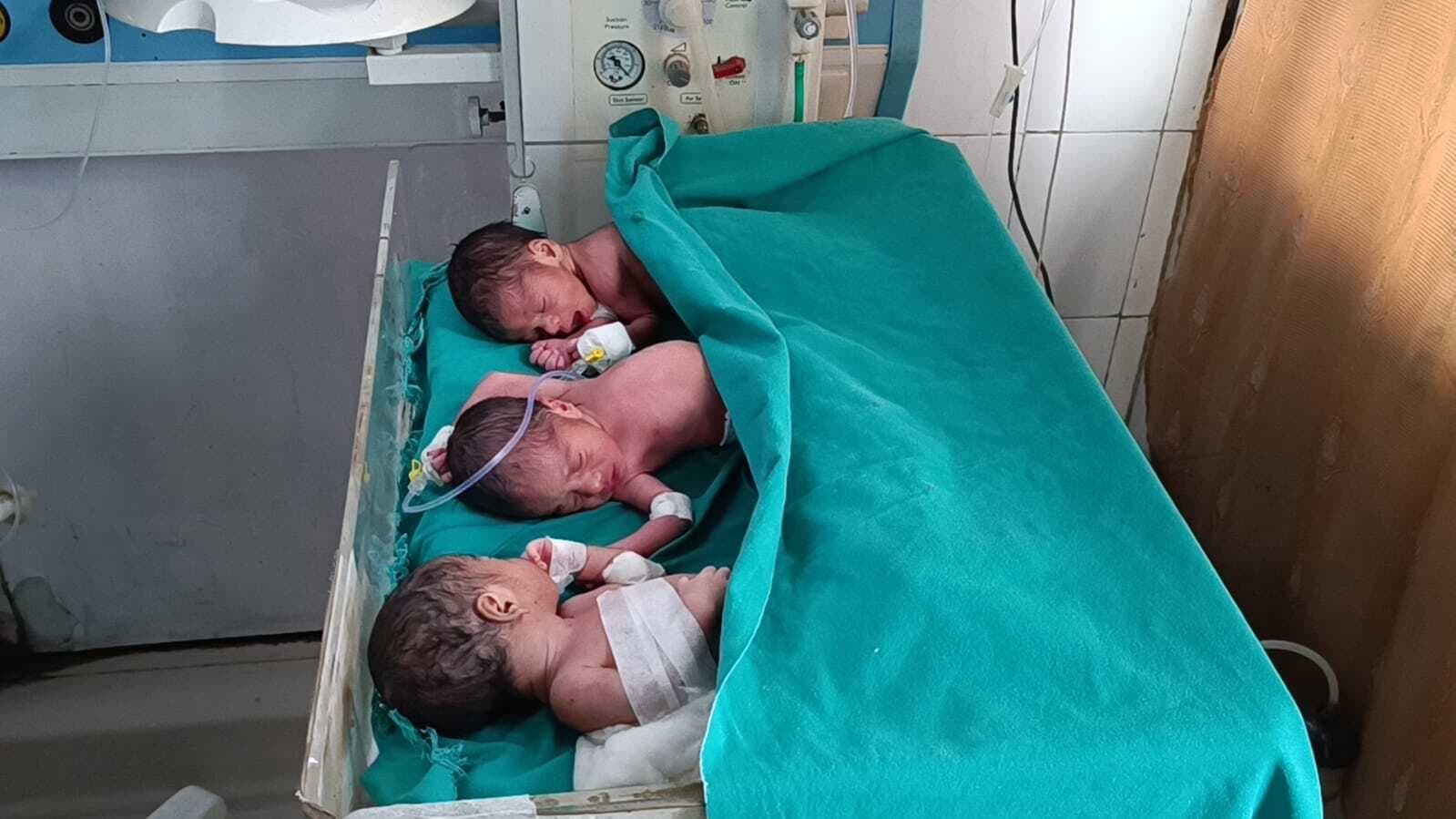 Dhanbad News : सदर अस्पताल में झरिया की महिला ने एक साथ तीन बच्चों को दिया जन्म