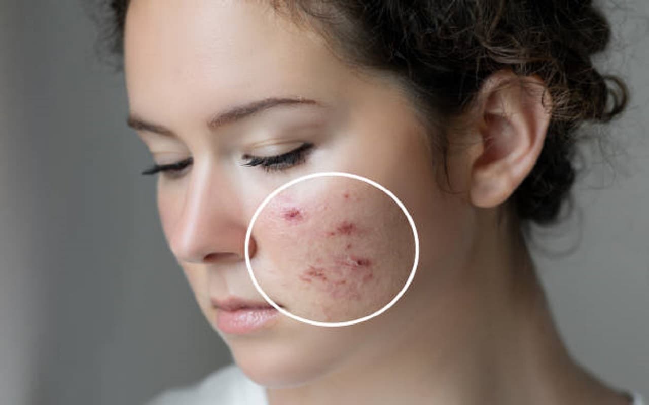 Monsoon Skin Care tips: बरसात के मौसम में त्वचा संबंधी समस्याओं से छुटकारा दिलाएंगे, ये घरेलू उपाय
