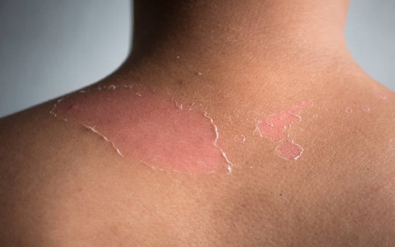 Self Care Tips: सन्बर्न से छुटकारा पाने के लिए कभी ना अपनाएं ये तरीके