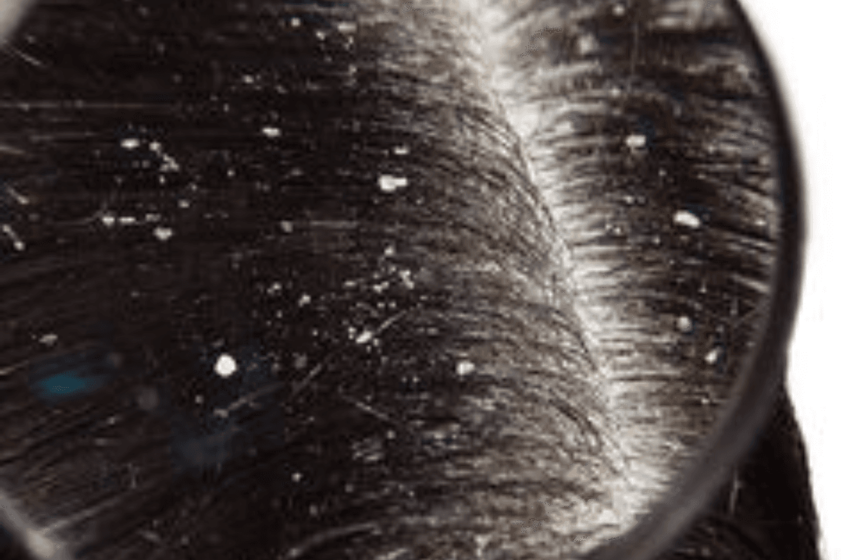 Home Remedies For Dandruff