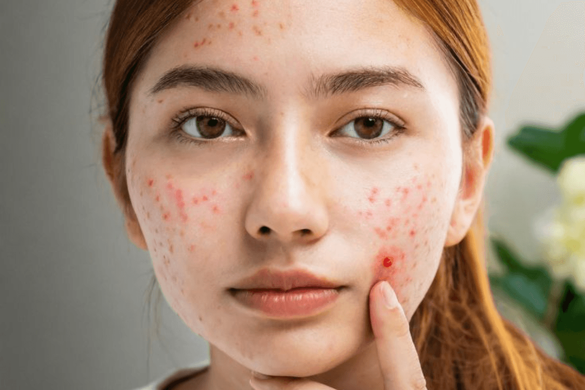 Is zandu balm safe for pimples: क्या आप भी लगाती हैं पिम्पल पर झंडू बाम?