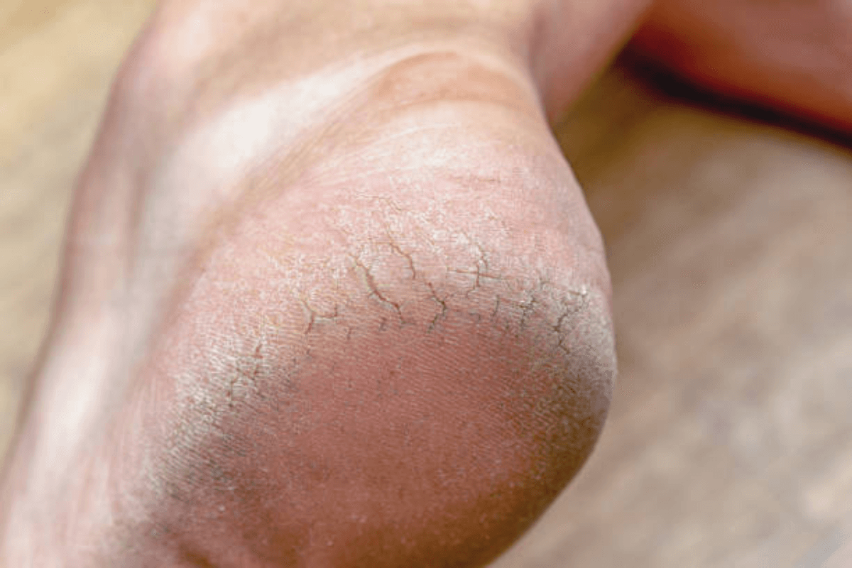 Skincare Tips: सर्दियों में एरिया लगी है फटने तो दादी - नानी के नुस्खे आएंगे काम, नहीं करनी पड़ेगी पॉकेट ढ़िली