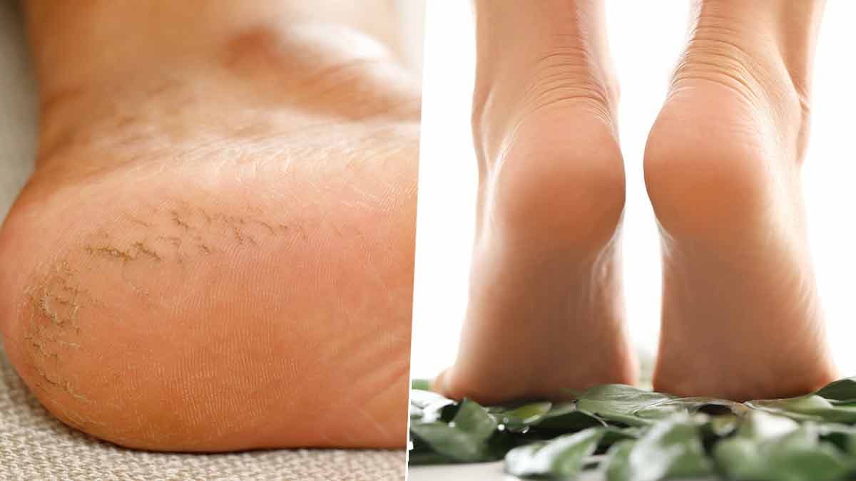 Winter Care Tips: सर्दी के मौसम में फटी एड़ियों को ठीक करें ये 5 टिप्स के साथ, जानिए