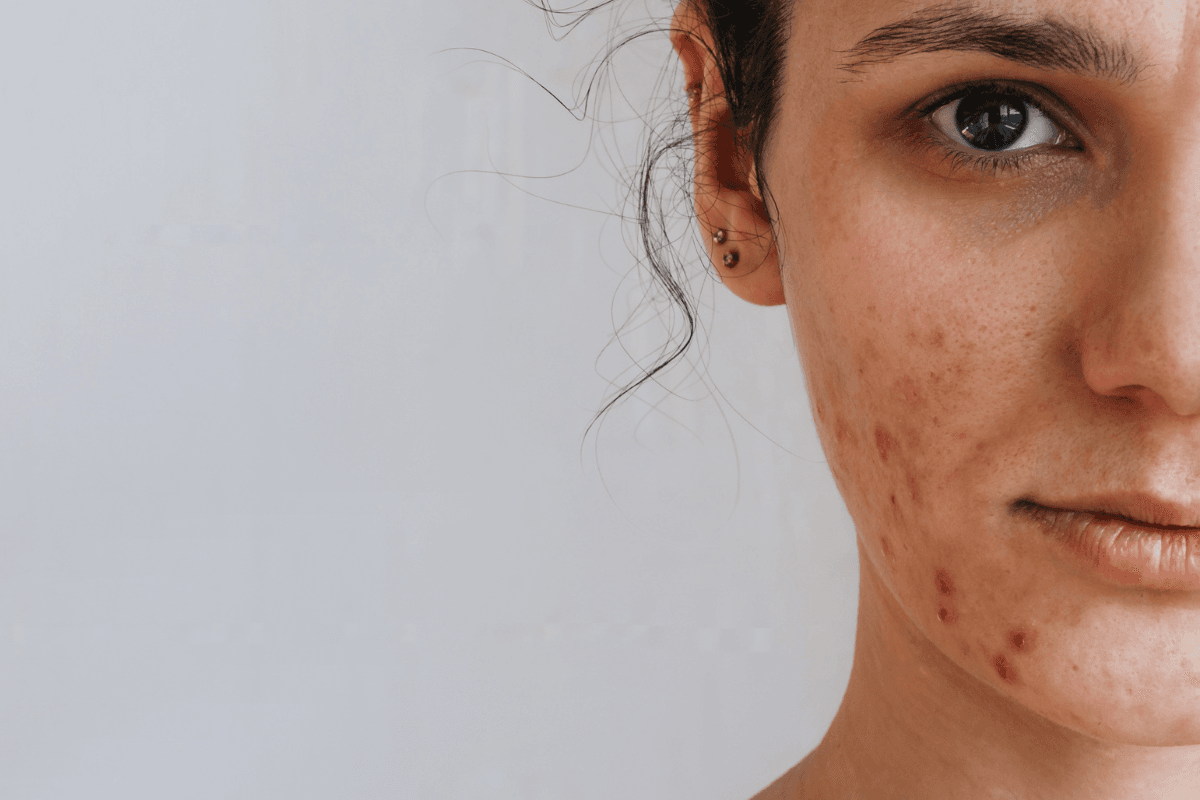 Top 5 Foods That May Cause Acne: चेहरे पर मुंहासे की समस्या से है परेशान तो बिल्कुल न खाएं ये 5 चीजे