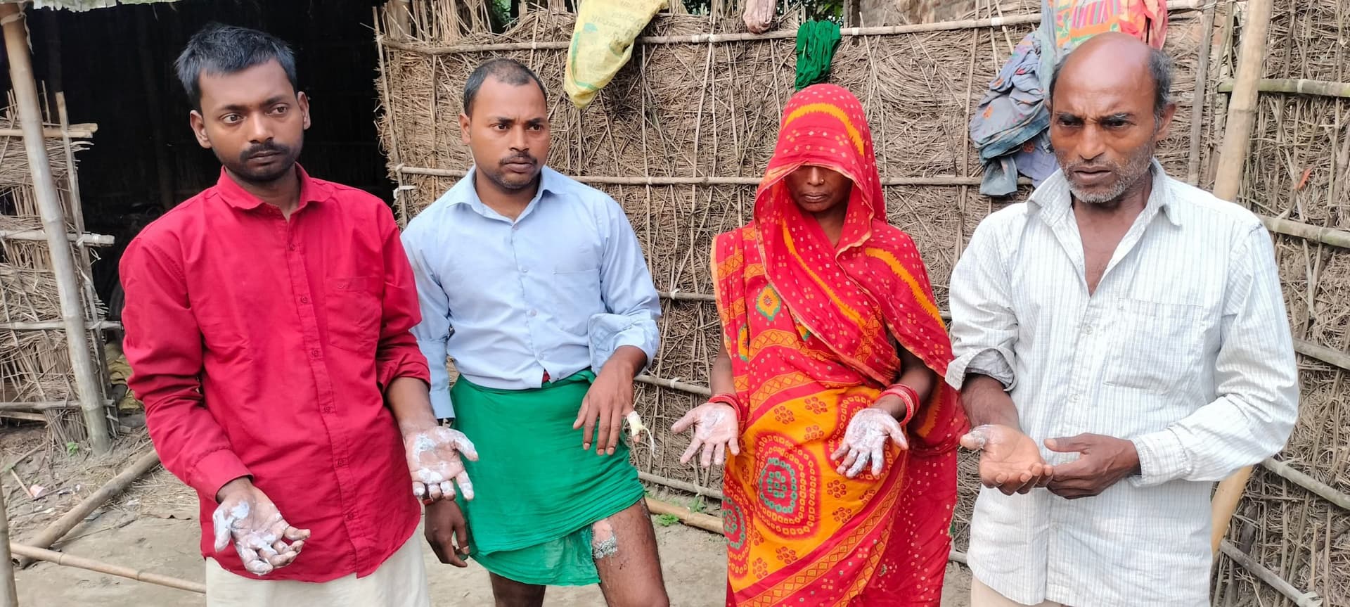 युवक के जेब में विस्फोट हुआ मोबाइल, एक महिला सहित परिवार के चार लोग झुलसे