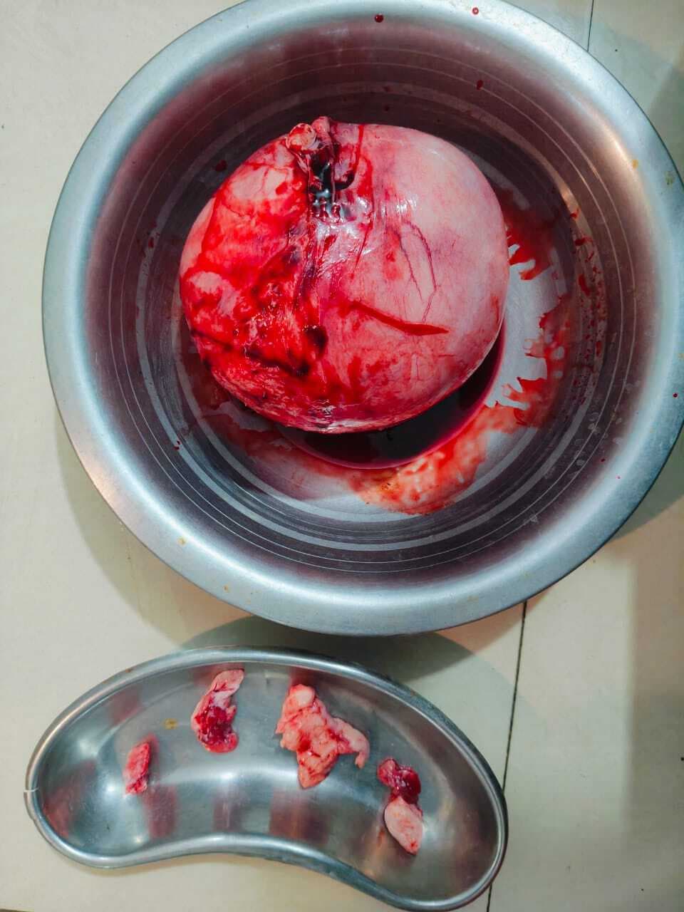 दो किलो का शिष्ट निकाल महिला को दिया जीवन दान