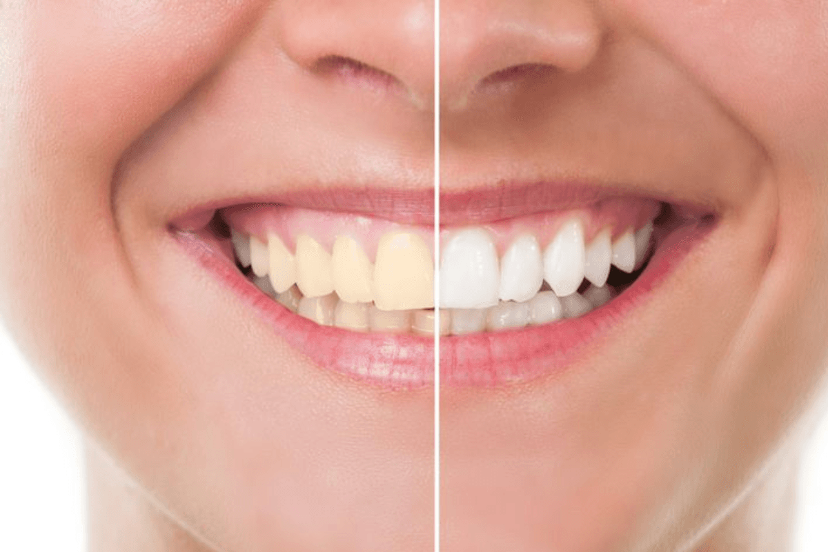 Home Remedies for Yellow Teeth