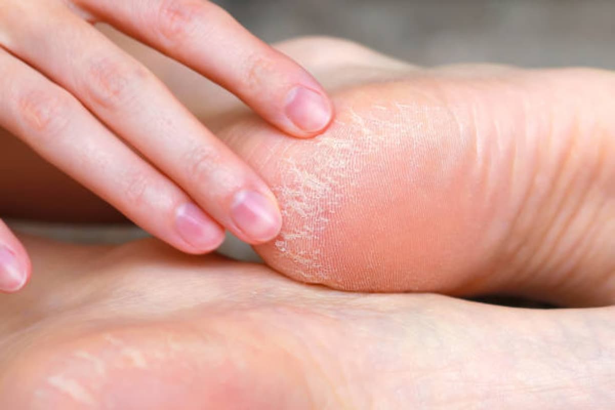 Winter Care Tips: फटी एड़ियों की जल्द भरेंगी दरारें, अपनाएं ये घरेलू नुस्खे