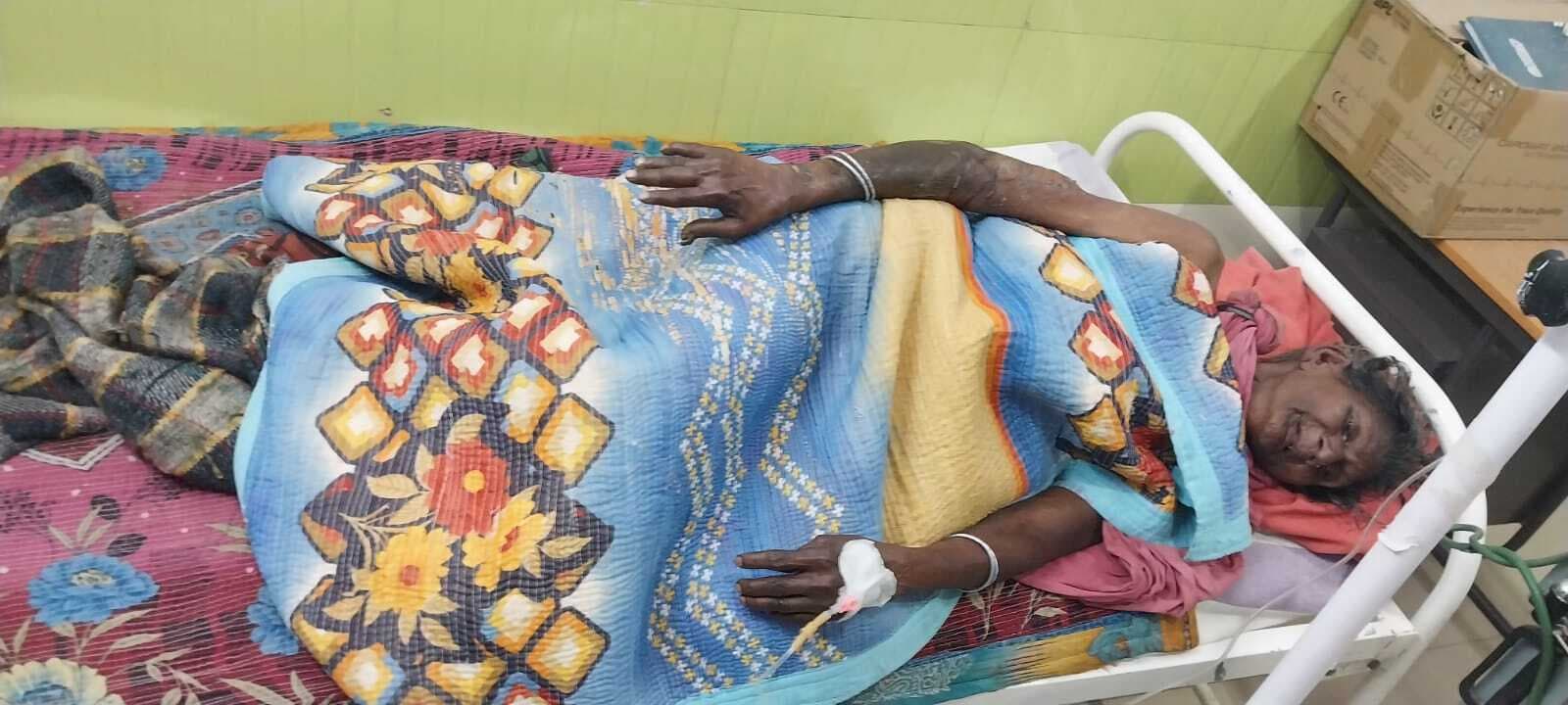 आग तापने के दौरान वृद्ध महिला जलकर हुई जख्मी