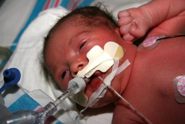 Patna News : जन्म के समय नहीं रोने वाले नवजातों में हो रही एसफिक्सिया की बीमारी