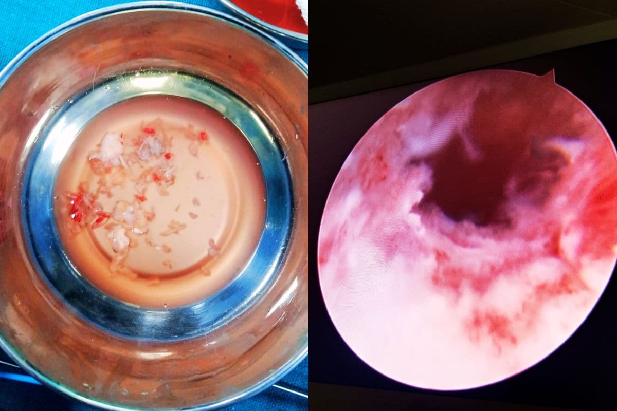 Ranchi News: 4 साल से महिला की बच्चेदानी में थी इतनी हड्डियां, ऐसे मिली मुक्ति