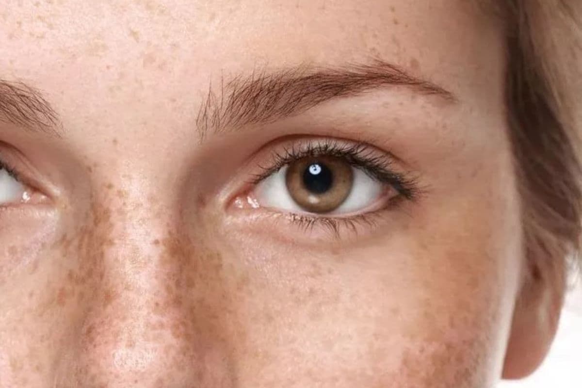 Skincare Tips: चेहरे की झाइयों से हैं परेशान, तो अपनायें यह घरेलू नुस्खें