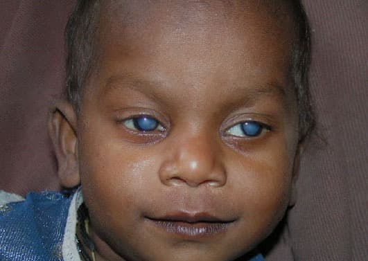 स्वास्थ्य सुविधाओं से वंचित महिलाओं व दृष्टि खो रहे बच्चों तक पहुंचना हमारी प्राथमिकता : डॉ भारती कश्यप