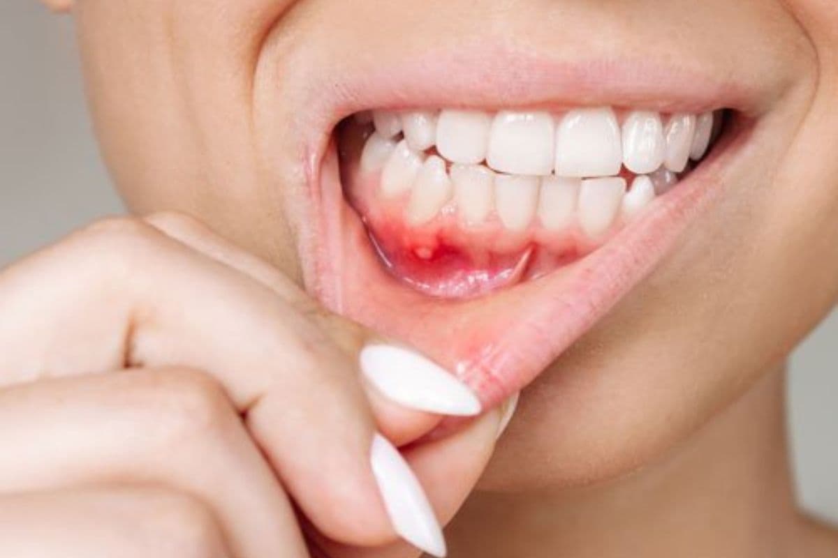 Causes Of Mouth Ulcers: मुंह के छालों से है परेशान तो अनदेखा करने की गलती न करें