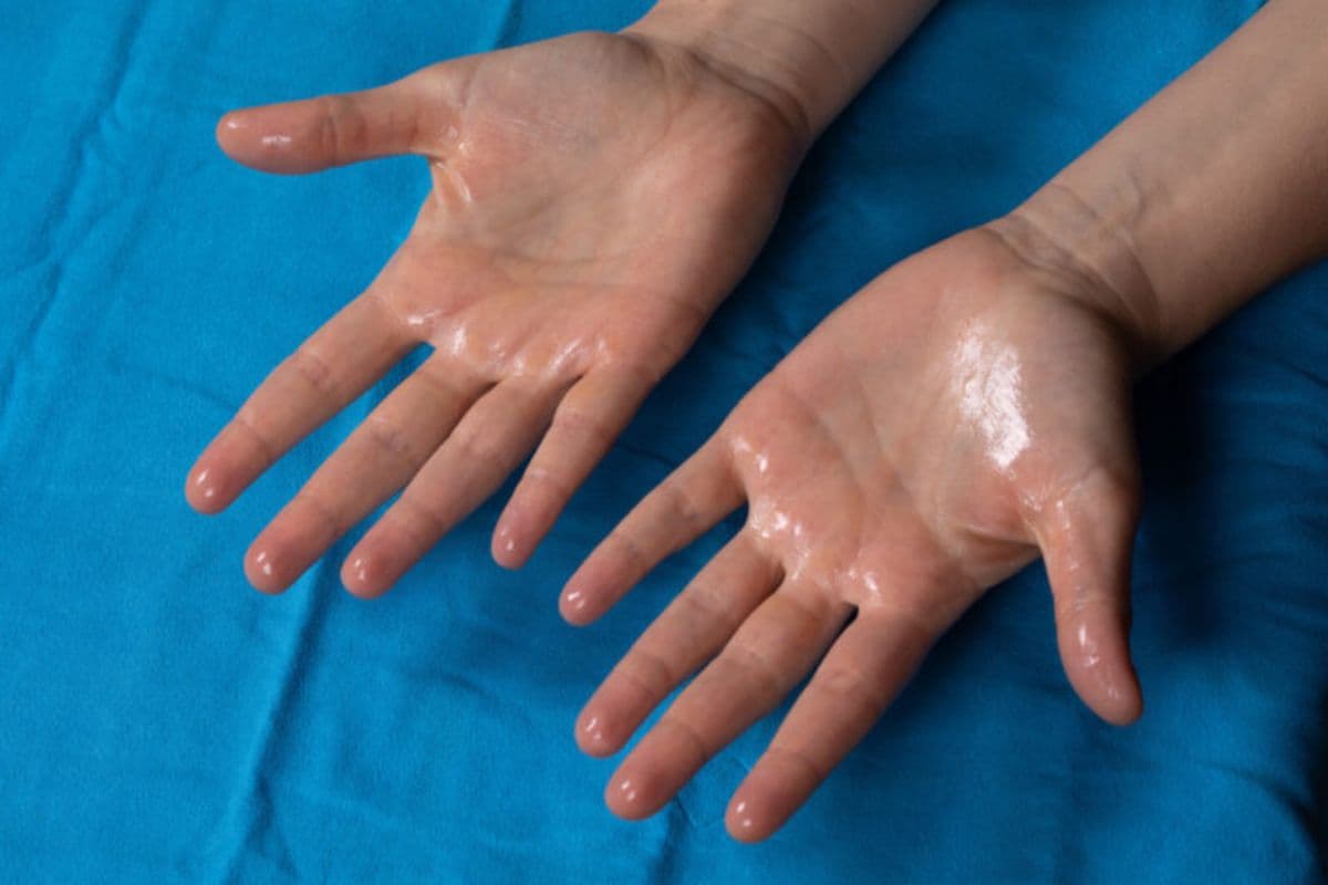 Hyperhidrosis: हथेली और तलवों में आता है हद से ज्यादा पसीना? हो सकता है हाइपरहाइड्रोसिस
