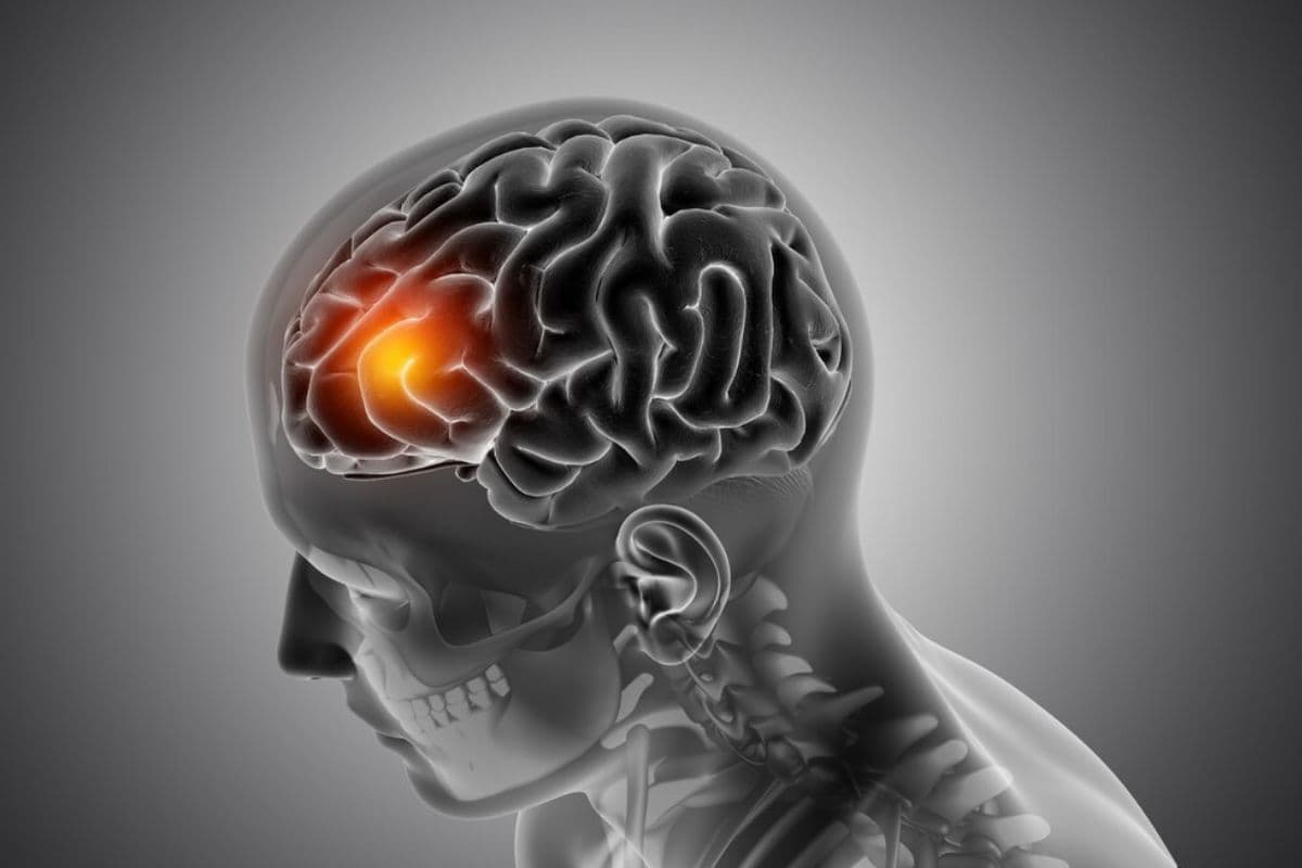 Health Tips: जानलेवा हो सकती है ब्रेन हेमरेज की समस्या, जानिए कारण और बचाव के तरीके