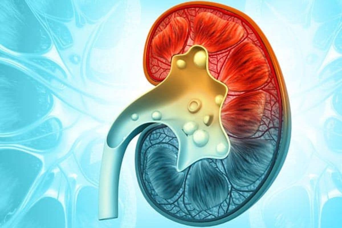Prevention of Kidney Stone: इन 5 आदतों को अपनाकर किडनी स्टोन के खतरे को कम करें