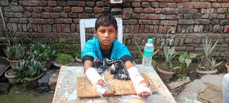 स्कूल की छत से गिरा छात्र, दोनों हाथ टूटा