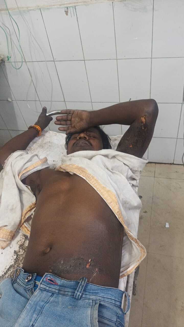 Dhanbad News: 33 केवीए बिजली करंट की चपेट में आकर झुलसा मजदूर