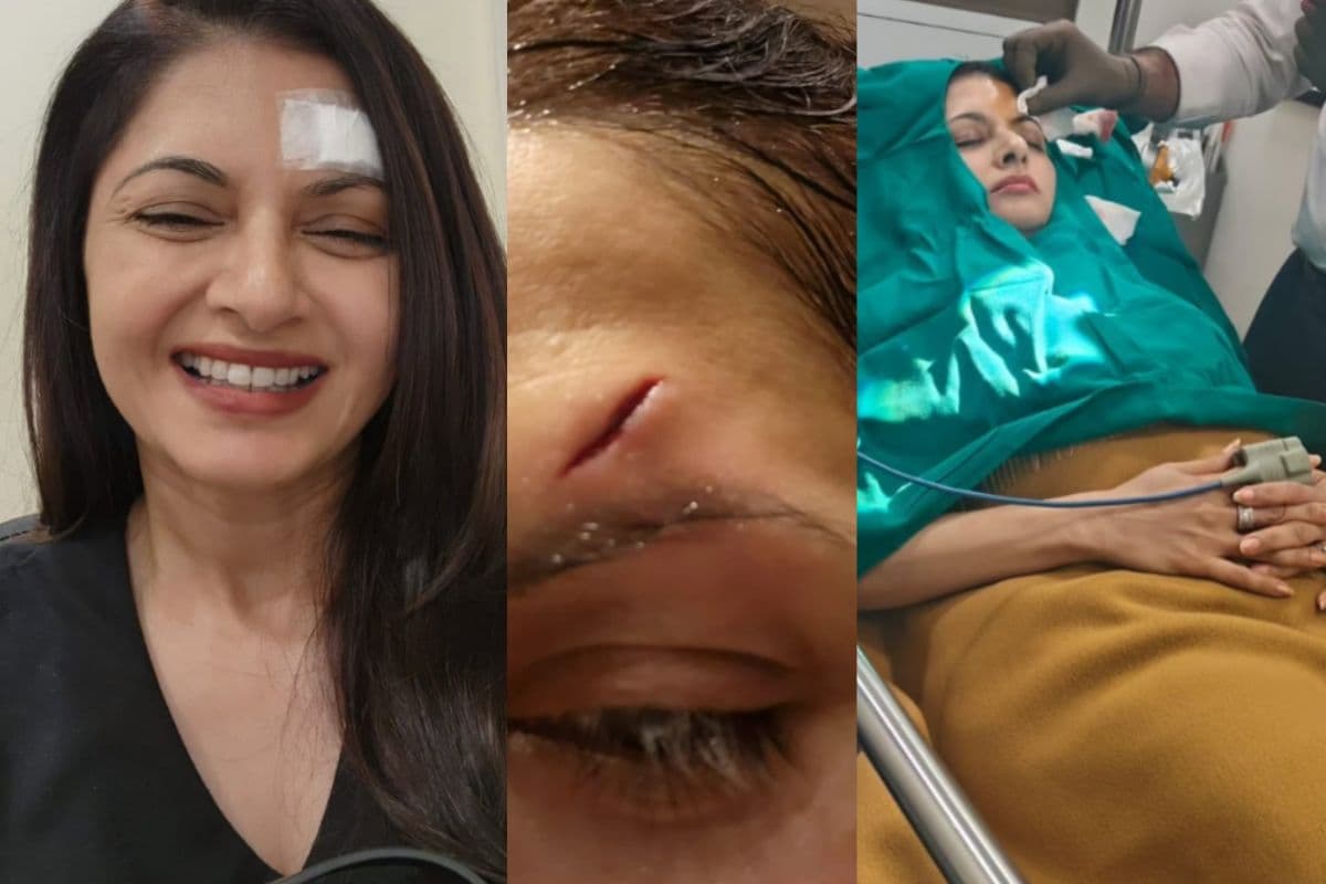 Bhagyashree के साथ होली से पहले हुआ बड़ा हादसा, माथे पर लगे 13 टांके, तस्वीरें देख फैंस का हाल बेहाल