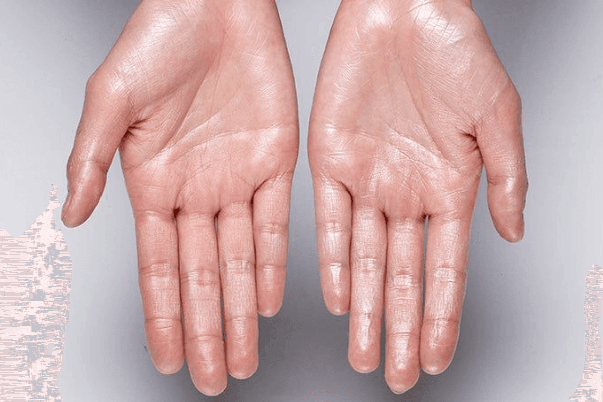 Sweaty Hands Problem in Summer: हथेलियों में बार-बार पसीना आना हो सकता है हाइपरहाइड्रोसिस
