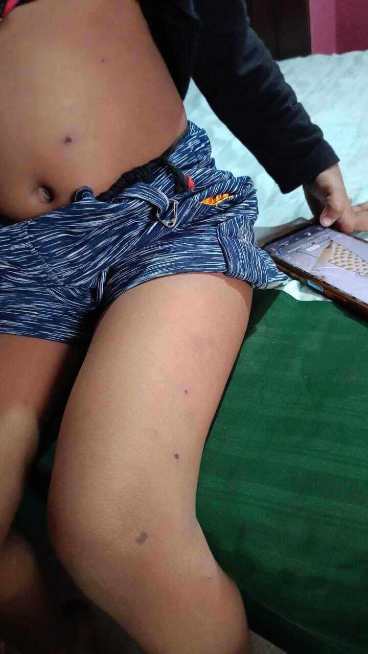 खावा राजपुर पंचायत में चेचक का बढ़ रहा प्रकोप,  35 लोग संक्रमित