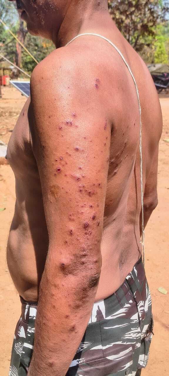 West Singhbhum News : सारंडा में मुठभेड़, नक्सलियों के आइइडी ब्लास्ट में सीआरपीएफ का एसआइ घायल