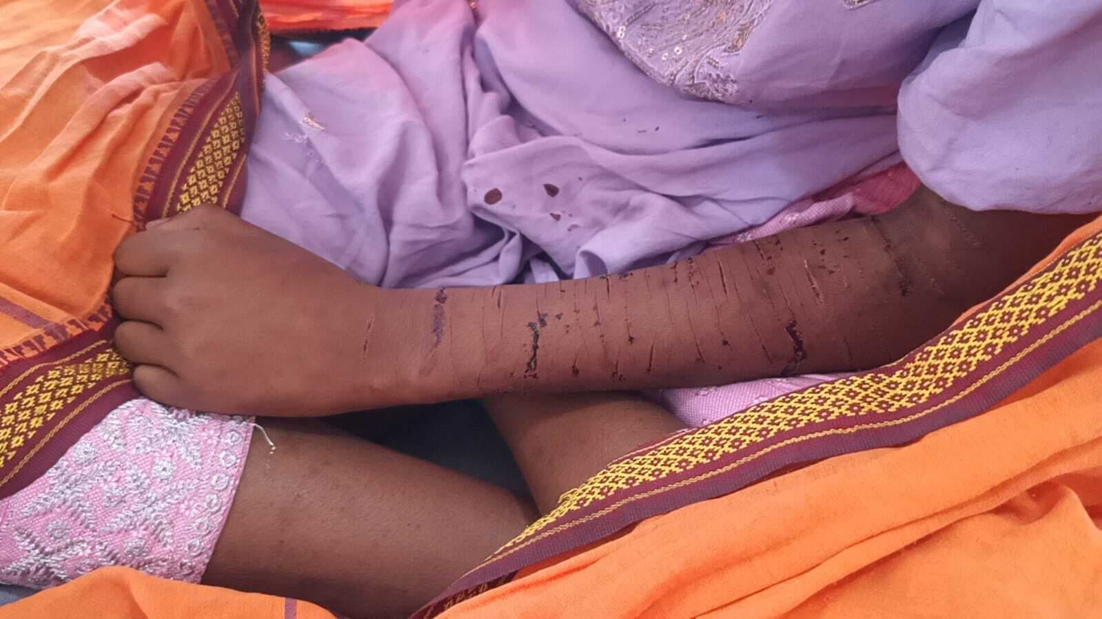 एप्पल का मोबाइल नहीं दिलाने पर युवती ने ब्लेड से काटा हाथ, जख्मी