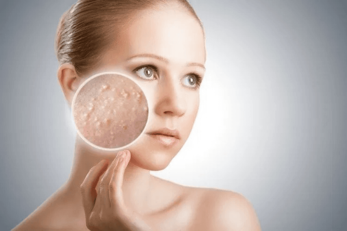 Home Remedies For Acne: गर्मी में चेहरे पर हो रहे छोटे छोटे दाने तो अपनाएं ये घरेलु नुस्खे, दूर होगी समस्या