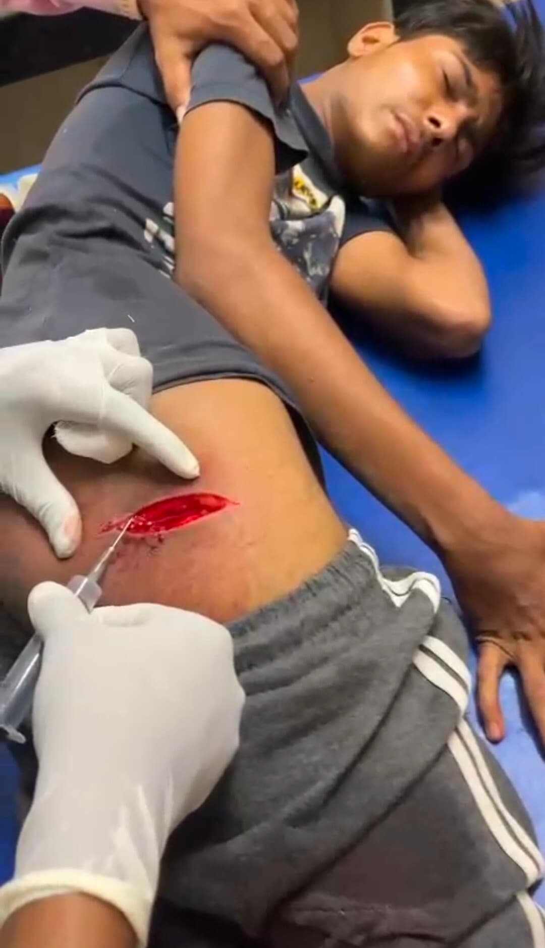 कटहल विक्रेता ने ग्राहक पर धारदार हथियार से किया प्रहार