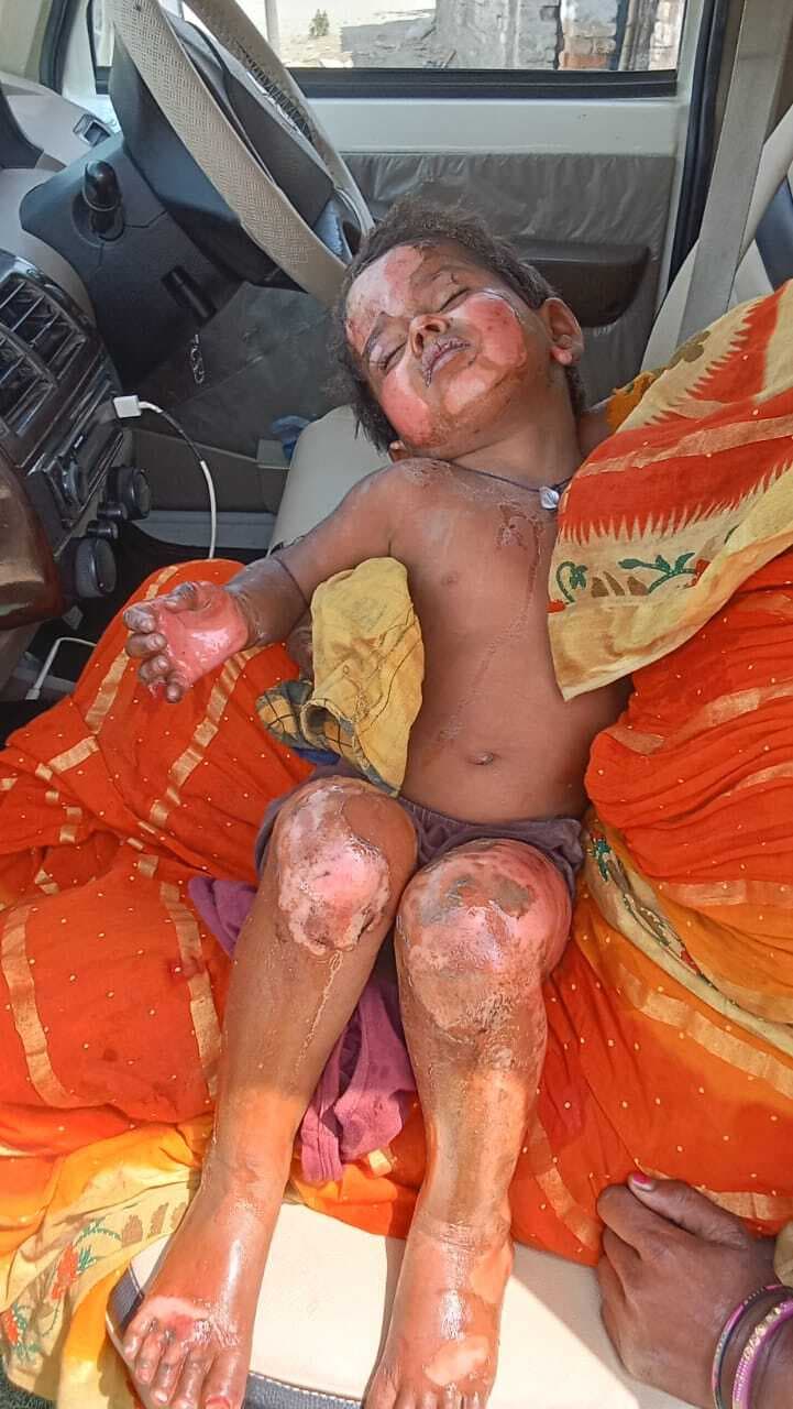 Motihari: चार लोगों का आशियाना जला, एक बच्ची झुलसी