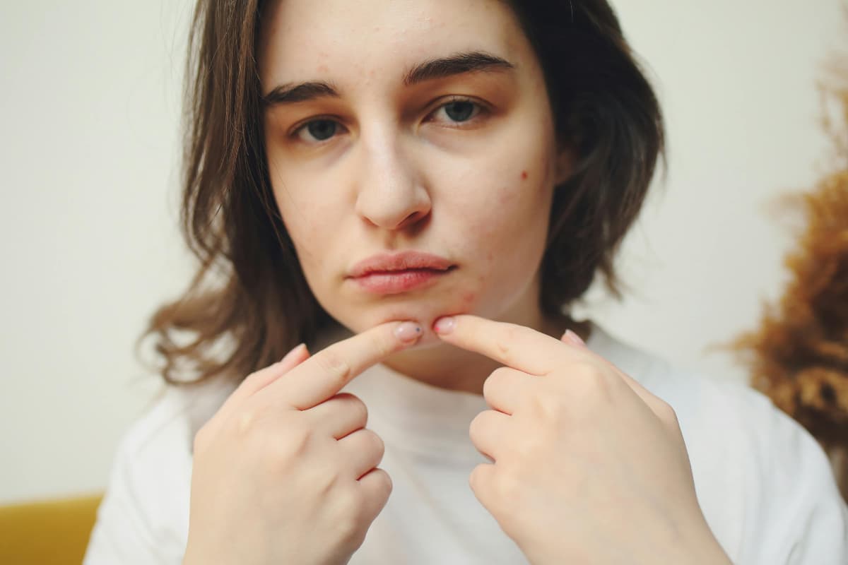 pimple cure pimple cure