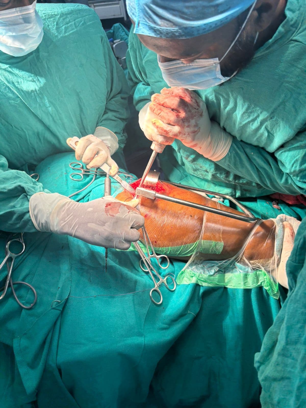 सदर अस्पताल में युवक के कूल्हे का किया गया सफलतापूर्वक प्रत्यारोपण