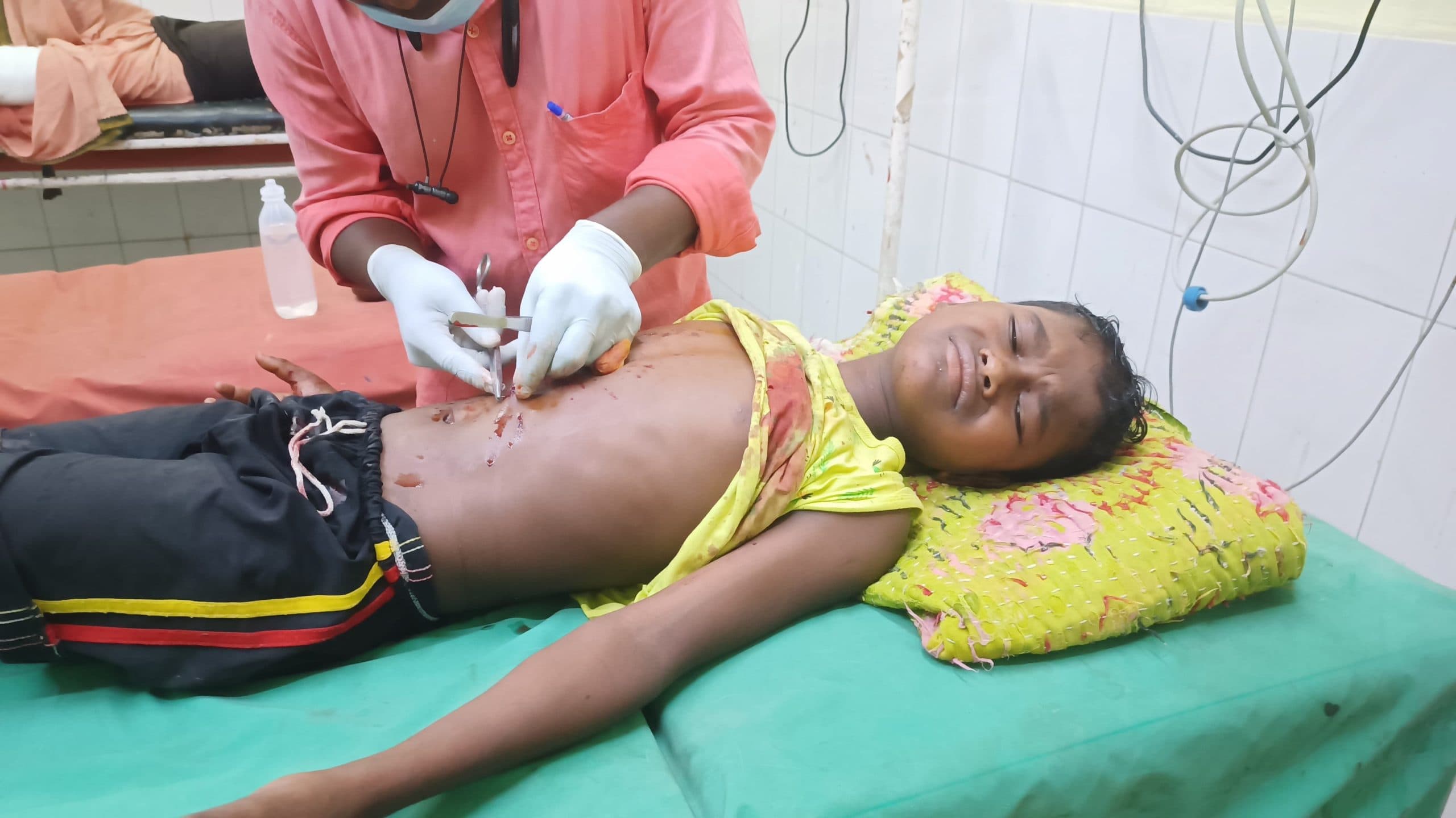 Dhanbad News : मोबाइल की बैट्री फटने से मासूम घायल