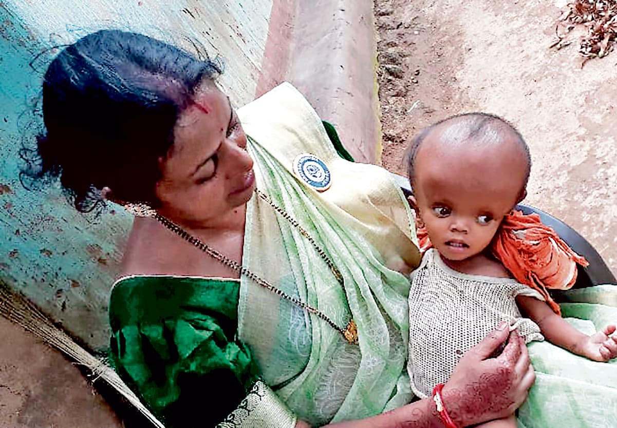 Chaibasa News : बच्ची का सिर लगातार बड़ा हो रहा, झाड़-फूंक से हो रहा इलाज