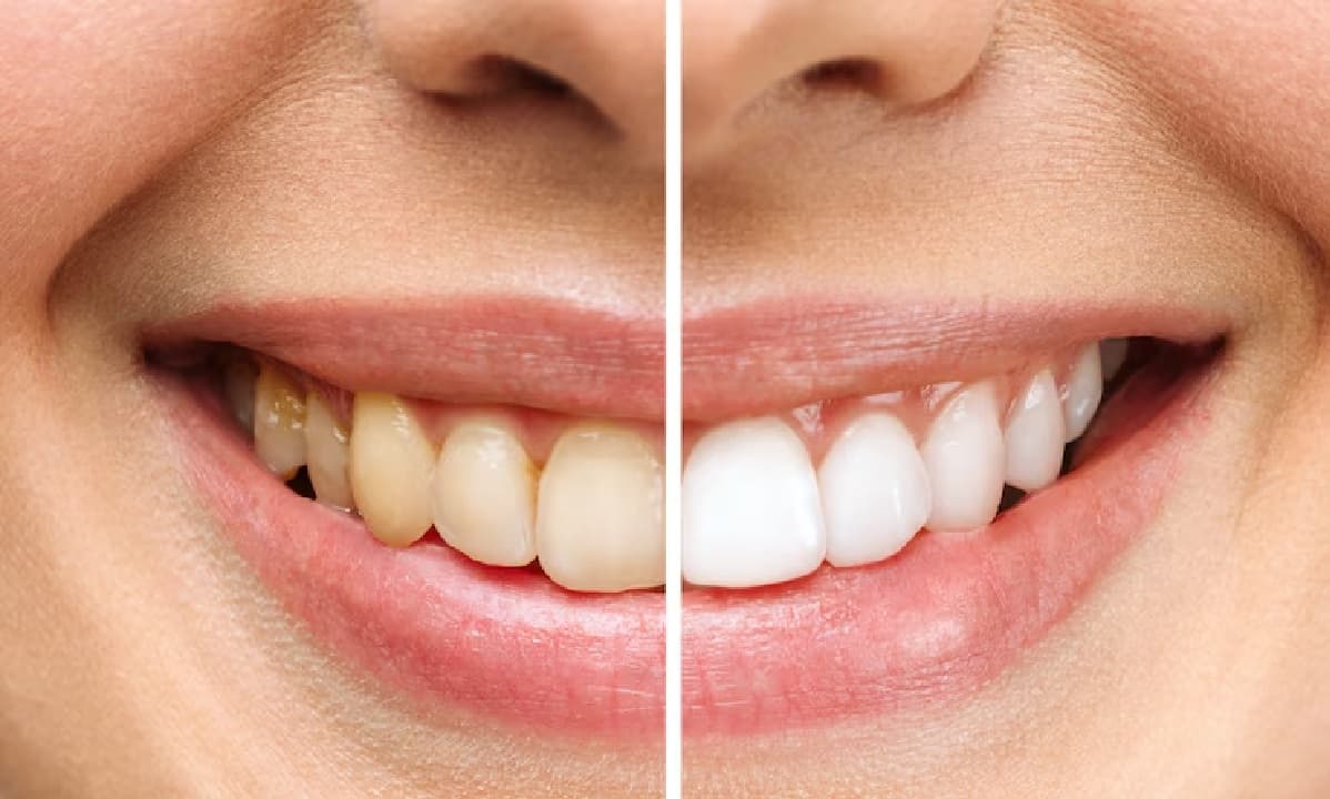 Dental Care Tips: नीम का ऐसे करें इस्तेमाल, बढ़ती उम्र में भी दांत रहेंगे मजबूत और स्वस्थ