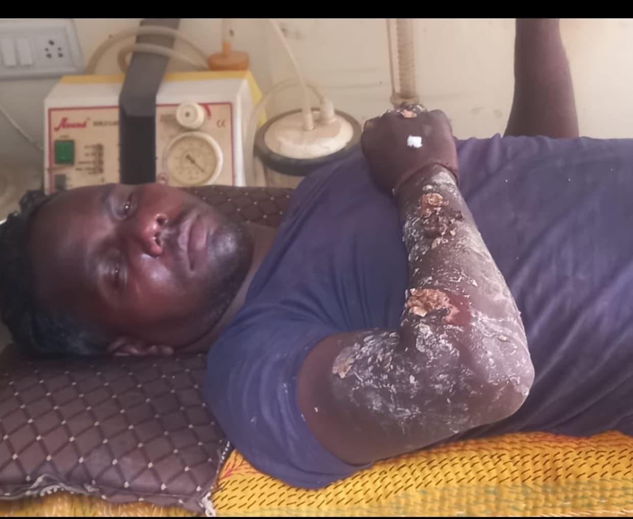 शॉर्ट सर्किट से दुकान में लगी आग, झुलसने से युवक घायल