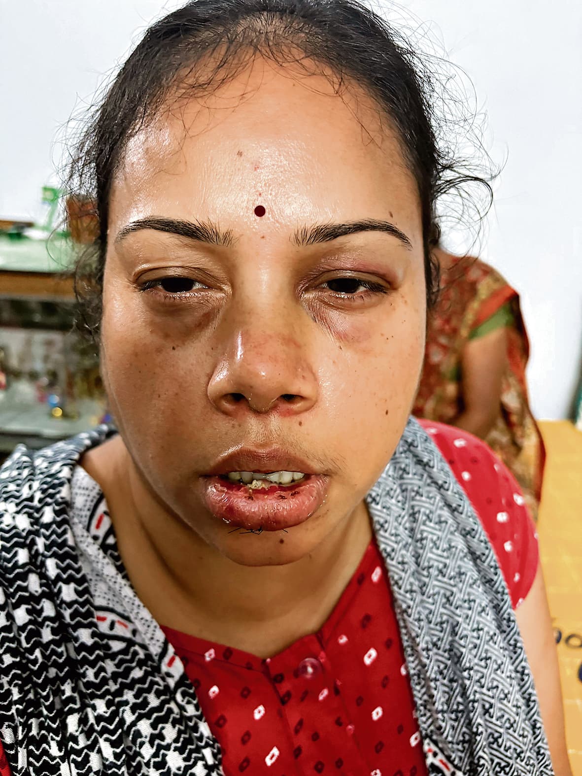 Jamshedpur News : टेल्को: पिता की देखभाल कर रही महिला से मारपीट, भाइयों के खिलाफ दर्ज करायी प्राथमिकी