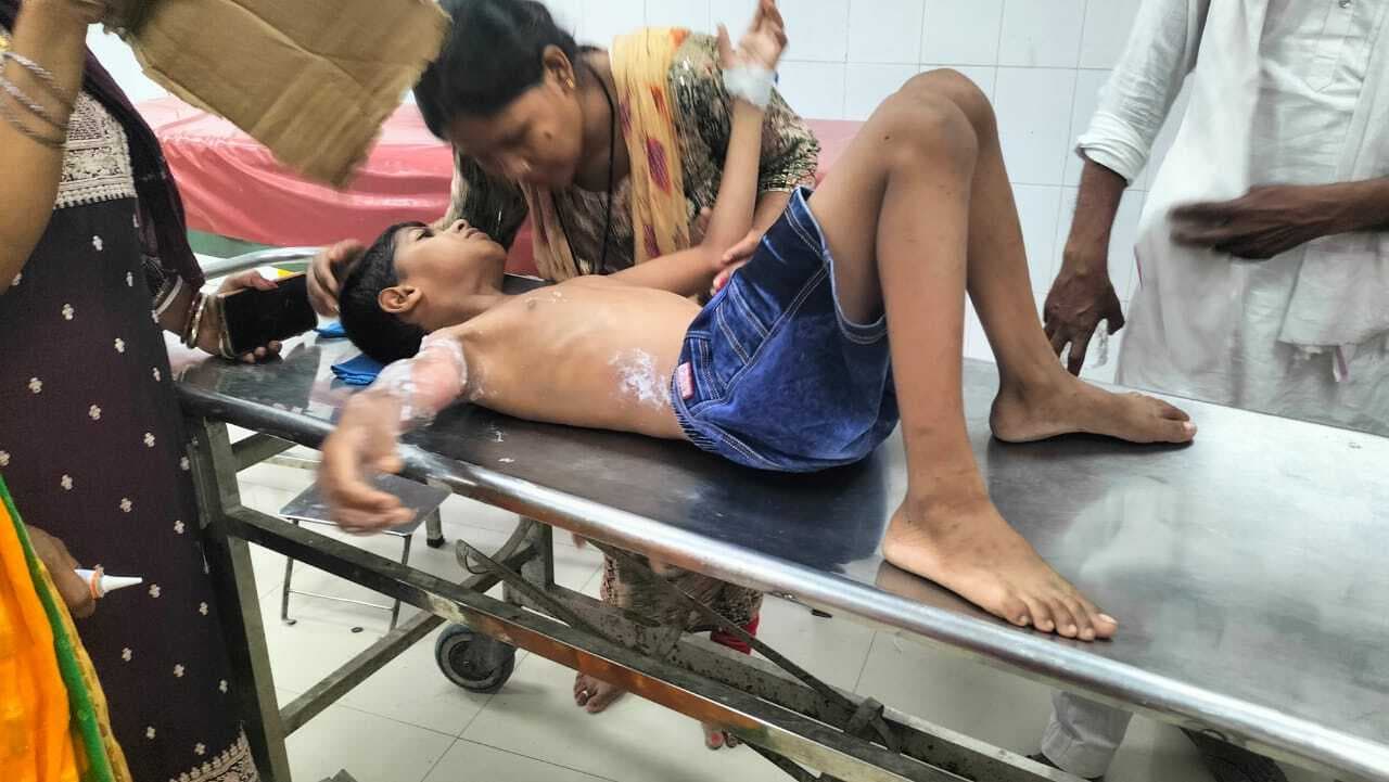 बारिश से बचने में गर्म तेल में गिरा सात वर्षीय बच्चा, झुलसा