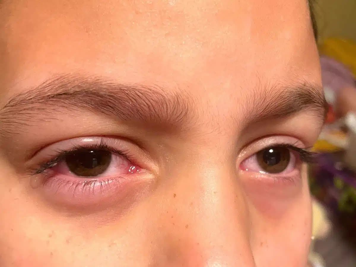 eye infection