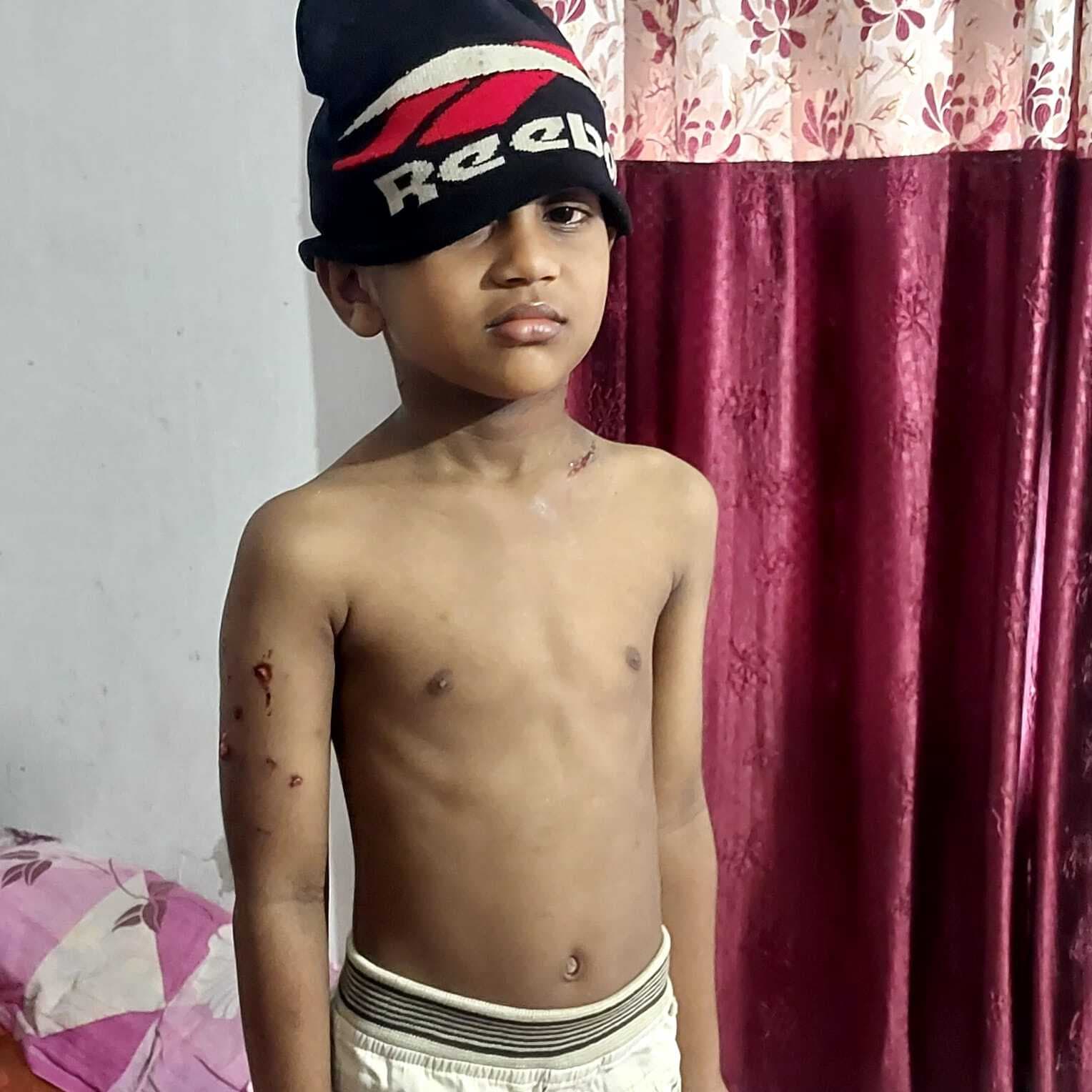 Jamshedpur News : बागबेड़ा कॉलोनी में बढ़ा आवारा कुत्तों का आतंक, एक बच्चे को काटा