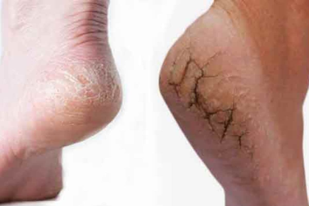 Cracked Heels Treatment: फटी एड़ियों की परेशानी? आजमाएं ये घरेलू उपाय और पाएं राहत