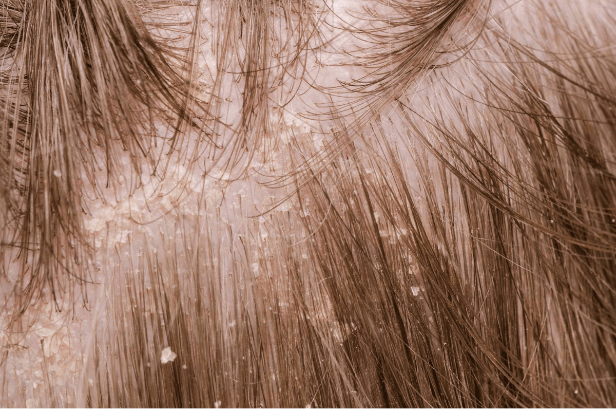 Dandruff Treatment