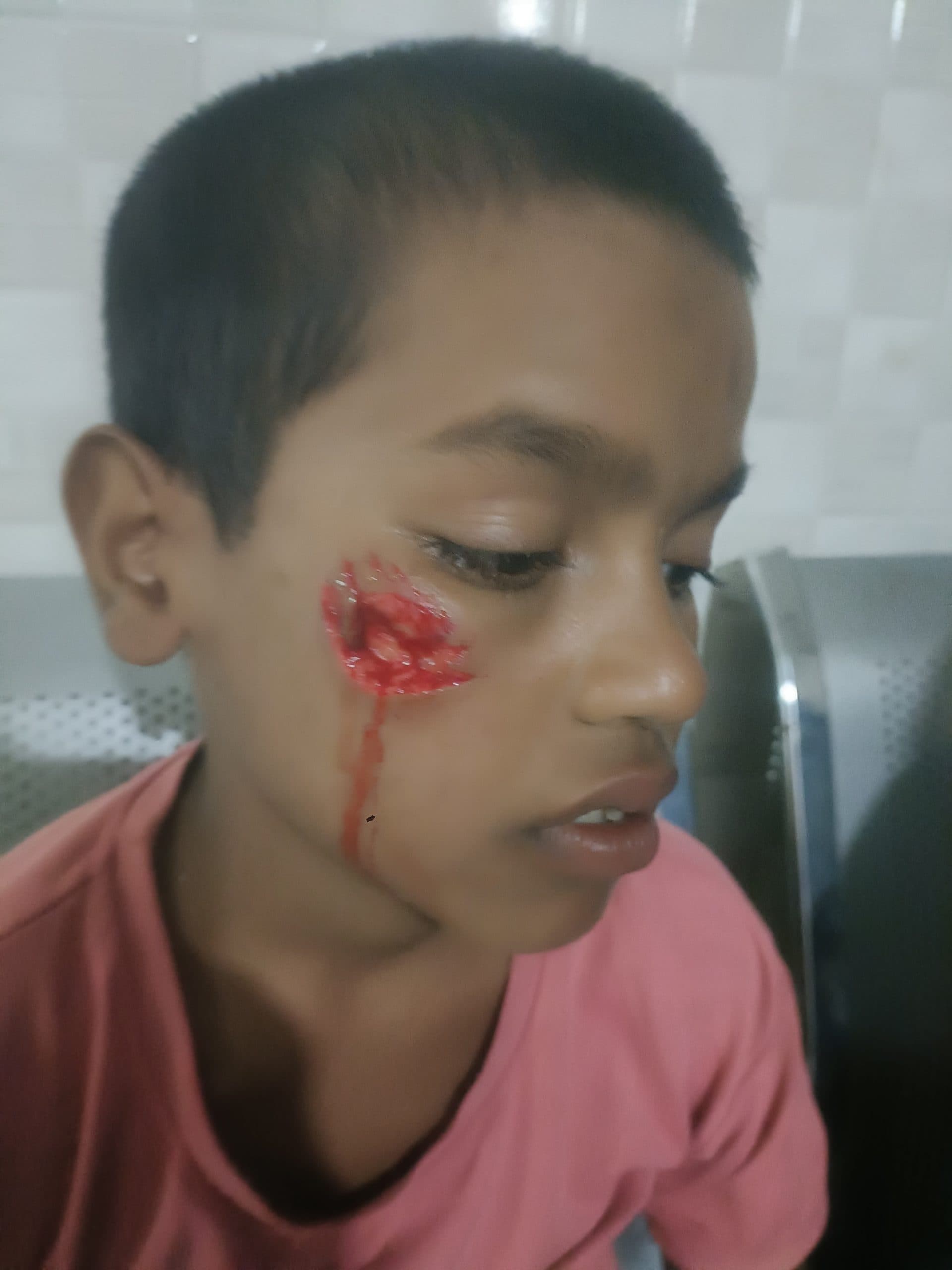 Giridih News: ट्यूशन से लौट रहे बच्चे को कुत्ते ने काटकर किया जख्मी