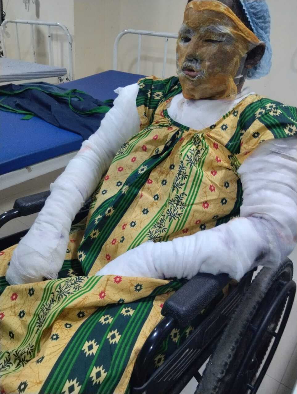 पति ने पत्नी को जिंदा जलाने का किया प्रयास, भर्ती